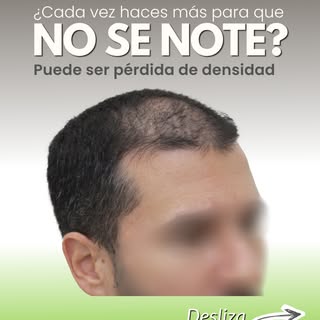 ¿Sientes que cada vez necesitas más gel, gorra o “un peinado estratégico” para cubrir entradas, coro