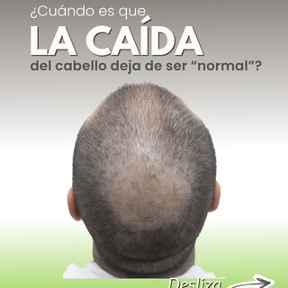 La caída del cabello no siempre se nota de golpe. Muchas veces empieza con entradas más marcadas, pé