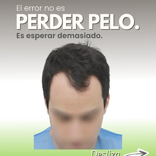 El error no es perder cabello. El error puede ser esperar demasiado para evaluar tus opciones.

La c