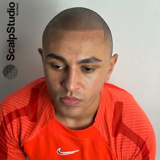 Summer scalp switch up 😮‍💨🔥

www.scalpstudio.com

•

#scalpmicropigmentation
#scalpmicropigmentat