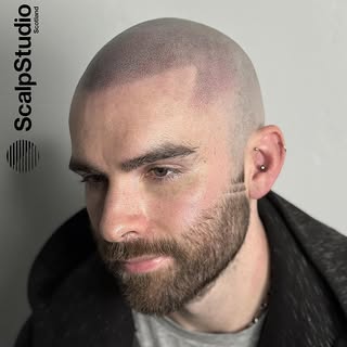New Hairline. New Confidence. 

www.scalpstudio.com

•

#scalpmicropigmentation
#scalpmicropigmentat