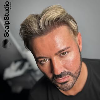 The beginning of @mrdeanrowland hair transplant density journey 🪡 

Thicker. Fuller. Natural. Our d