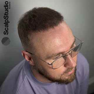 That Friday feeling hits harder when your Hair Transformation is this clean 🔥

www.scalpstudio.com
