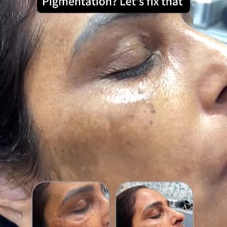 Dark circles aren’t always just about pigmentation or lack of sleep.

If the under-eye skin has beco