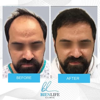 The DHI technique applied with the implanter pen is a direct hair transplant application, it is also