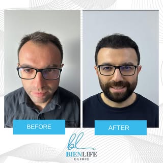 The DHI technique applied with the implanter pen is a direct hair transplant application, it is also