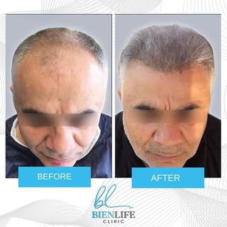 The DHI technique applied with the implanter pen is a direct hair transplant application, it is also