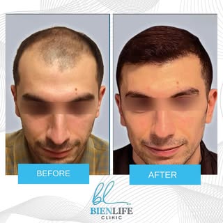 The DHI technique applied with the implanter pen is a direct hair transplant application, it is also