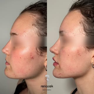 ✨ Transformación total con Full Face ✨

🔹 Rinomodelación: elevamos la punta de la nariz.
🔹 Aumento
