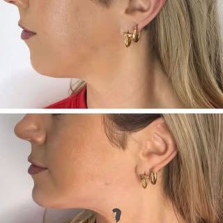 Lipoláser de papada 

Con nuestro tratamiento de lipoláser de papada, conseguimos definir el contorn