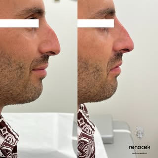 ✨ Antes y Después | Rinomodelación ✨

Resultados naturales y armoniosos sin cirugía. En este caso, s