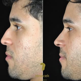 Hoy, queremos mostraros este nuevo caso de rinoplastia.

Cada nariz es única, por eso cada tratamien