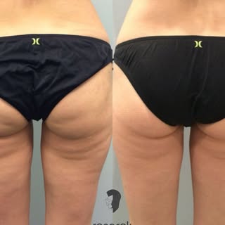 ❄️ Resultados tras 6 sesiones de criolipólisis ❄️

La criolipólisis es un tratamiento no invasivo qu