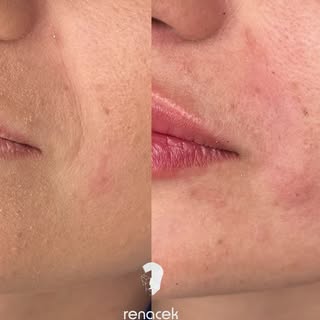✨ Surcos nasogenianos: antes y después ✨

Un pequeño cambio puede aportar un aspecto mucho más fresc