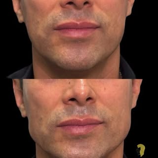 Marcación mandibular masculina: definición y equilibrio facial 💉

Una mandíbula bien definida puede