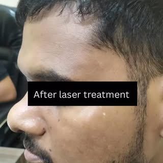 ✨ Tired of stubborn dark patches or uneven skin tone?At Mannat Hospital, we offer personalized treat