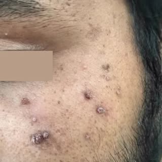#ambaladoctor #dermatologist #mannathospital #lasertreatment