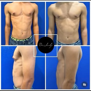 Gynecomastia Before and After… what a difference! 🤯 

We see men all the time for gynecomastia, lip