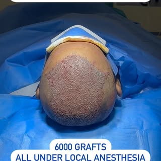 Worried about baldness?
Follow @dr.sreekar.harinatha

Hair Transplantation is now done using fine Sa