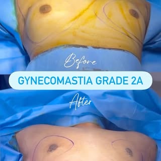 Why choose Dr Sreekar Harinatha? @dr.sreekar.harinatha 
✔ Focused expertise in gynecomastia correcti