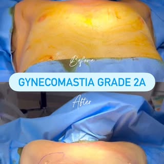 Follow @dr.sreekar.harinatha Confidence restored, one step at a time.

Gynecomastia isn’t just about