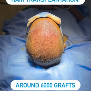 Follow @dr.sreekar.harinatha Stronger hair. Sharper results. 

Introducing Sapphire FUE Hair Transpl