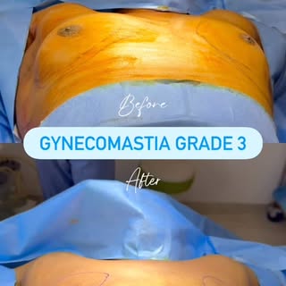 Follow.l @dr.sreekar.harinatha Grade 3 Gynecomastia Transformation

A challenging case of Grade 3 gy