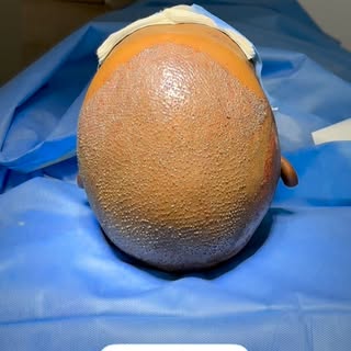 Follow @dr.sreekar.harinatha Restoring confidence, one follicle at a time.

Sapphire FUE Hair Transp