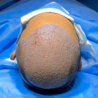 Follow @dr.sreekar.harinatha Every great transformation begins with a single step.

With Sapphire FU