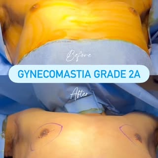 Follow @dr.sreekar.harinatha Grade 2A Gynecomastia Correction

A combination of liposuction and glan