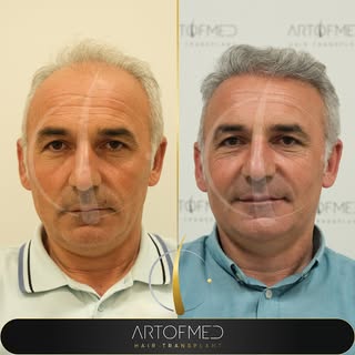 8th month after hair transplantation 

Art Of Med Clinic Saç Ekimi • 

beyond your expectation
• Bea