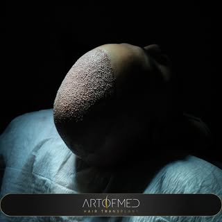 Art Of Med Clinic Saç Ekimi • 

Sedation hair transplantation 

Densification process with DHI techn