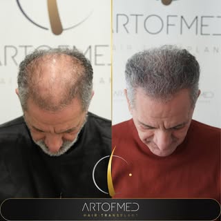 Art Of Med Clinic Saç Ekimi • 

beyond your expectation
• Beard transplant
• Saphirre Fue Hair Trans