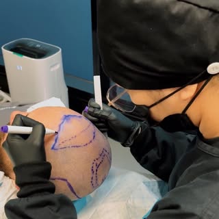 𝗛𝗮𝗶𝗿 𝗧𝗿𝗮𝗻𝘀𝗽𝗹𝗮𝗻𝘁 | 𝗣𝗿𝗲𝗽𝗮𝗿𝗮𝘁𝗶𝗼𝗻 𝘁𝗼 𝗣𝗿𝗼𝗰𝗲𝗱𝘂𝗿𝗲

This video provides 
