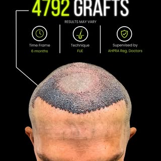 𝗛𝗮𝗶𝗿 𝗧𝗿𝗮𝗻𝘀𝗽𝗹𝗮𝗻𝘀𝘁 | 𝗖𝗹𝗶𝗻𝗶𝗰𝗮𝗹 𝗖𝗮𝘀𝗲 𝗦𝘂𝗺𝗺𝗮𝗿𝘆

A patient presenting wit