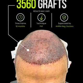 𝗛𝗮𝗶𝗿 𝗧𝗿𝗮𝗻𝘀𝗽𝗹𝗮𝗻𝘁 | 𝗖𝗹𝗶𝗻𝗶𝗰𝗮𝗹 𝗖𝗮𝘀𝗲 𝗦𝘂𝗺𝗺𝗮𝗿𝘆

A patient presenting with 