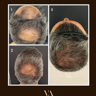 1. Antes de las cirugías
2. ⁠Después de la 1ª cirugía (zona frontal)
3. ⁠Después de la 2ª cirugía (c