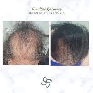 Alopécia Androgenética 

Resultado parcial de 3 meses.

Cada caso é um caso, cada resposta é única.
