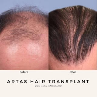 Unlock the secret to natural-looking hair restoration with Artas Hair Transplant at the Global Cente