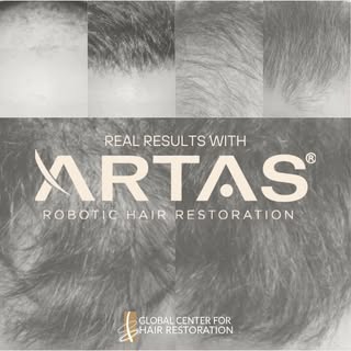 Here at the @globalcenterforhairrestoration, we’re proud to be one of the first #Nashville clinics t