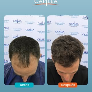 ¿Qué puede pasar en 1 año?

Esto. Un cambio visible, natural, y duradero.

Recuperar tu cabello es p