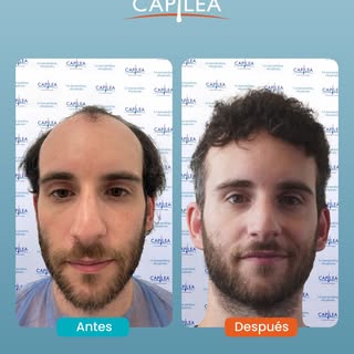 Así luce un resultado real, sin promesas exageradas ni sorpresas.

En Capilea trabajamos con honesti