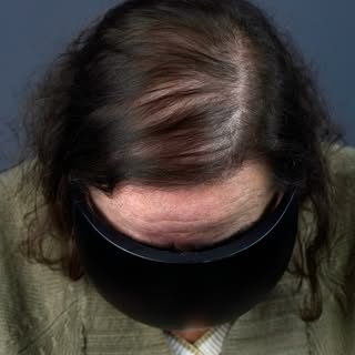 La pérdida de densidad no entiende de género. ✨
Arantxa quería volver a verse con un cabello más den