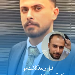‎🔹 تفاوت را ببینید، اعتمادبه‌نفس را احساس کنید!
‎در مرکز تخصصی کاشت موی فرمانی تبریز، با جدیدترین ت