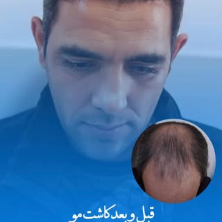⁨	⁨	⁨	⁨	‎🔁 قبل و بعد؟
‎نه فقط عکس، بلکه داستانیه از بازگشت به خودِ واقعی.
‎وقتی موها برمی‌گردن، فقط