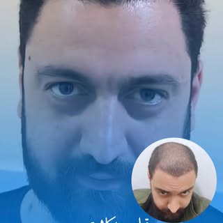 قبل و بعد از کاشت مو در مرکز فرمانی تبریز
طبیعی‌ترین نتیجه با تیم پزشکی مجرب و تکنیک‌های روز دنیا.
ز