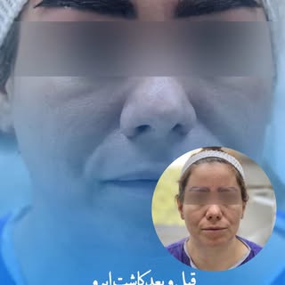 ⁨	⁨	⁨	بازسازی قاب چهره با کاشت ابرو

وقتی ابروها کم‌پشت می‌شن، چیزی فراتر از زیبایی از دست می‌ره — ح