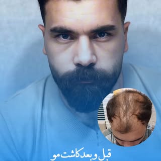 تفاوت را در تصویر ببینید 
قبل و بعد از کاشت مو در مرکز تخصصی کاشت موی فرمانی تبریز.
ما فقط مو نمی‌کا