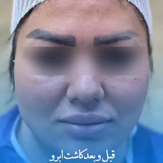 طراحی خط ابرو با دقت میلی‌متری، کاشت با تراکم بالا، نتیجه‌ای ماندگار.
در مرکز تخصصی کاشت موی فرمانی،