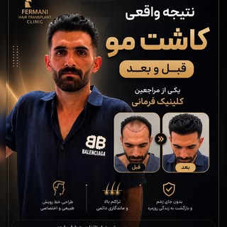 ✨ نتیجه واقعی، اعتماد واقعی

ریزش مو می‌تواند روی ظاهر و اعتمادبه‌نفس تأثیر بگذارد، اما با یک کاشت م